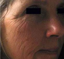 Fine Lines & Wrinkles Before Treatment